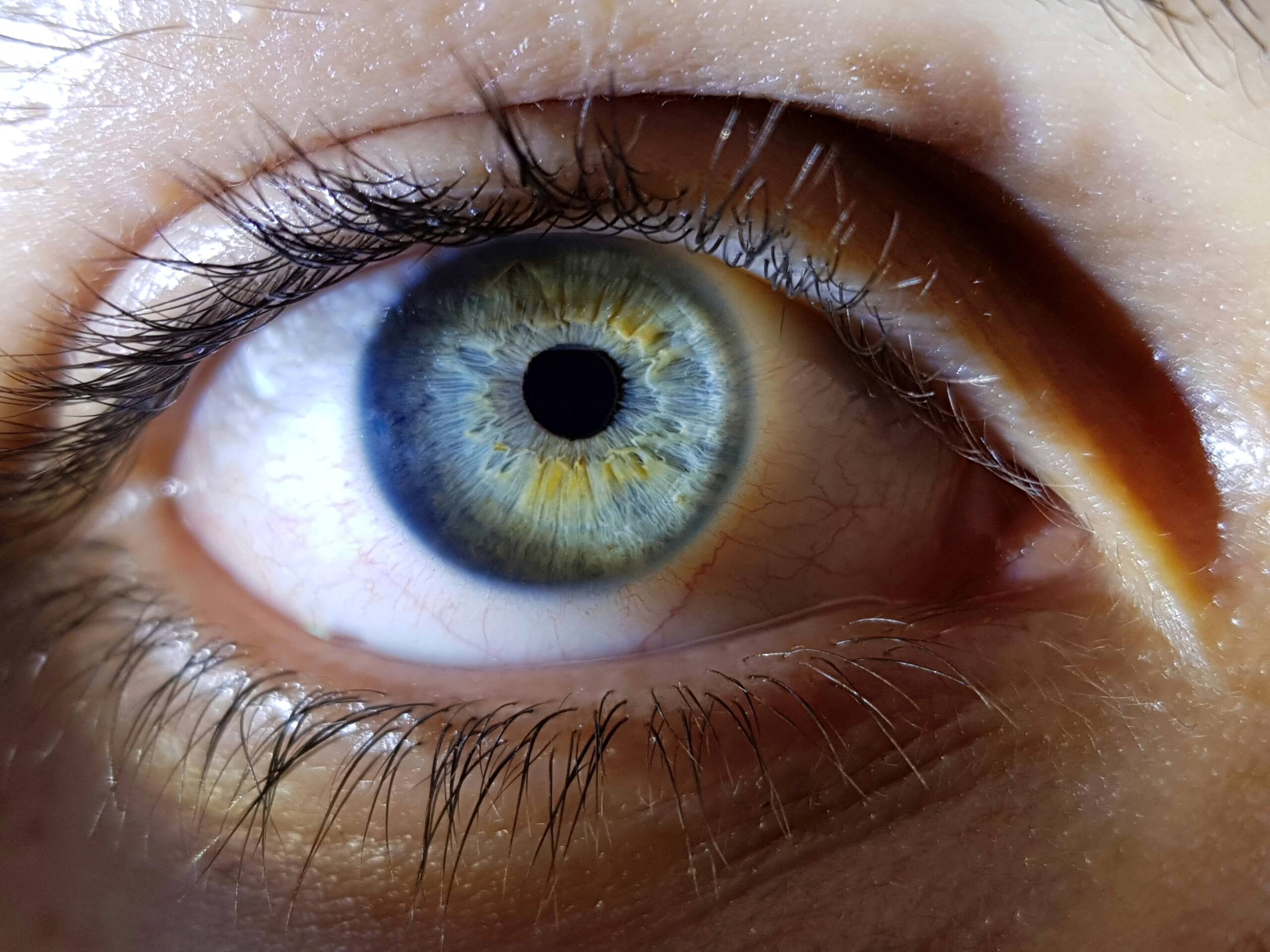 Irisdiagnose